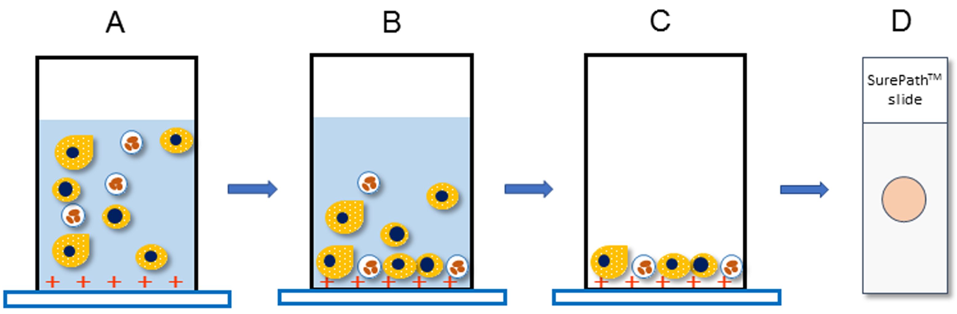 Quantifying Podocytes and Parietal Epithelial Cells in Human Urine ...