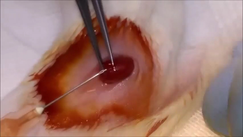 Islet transplantation.