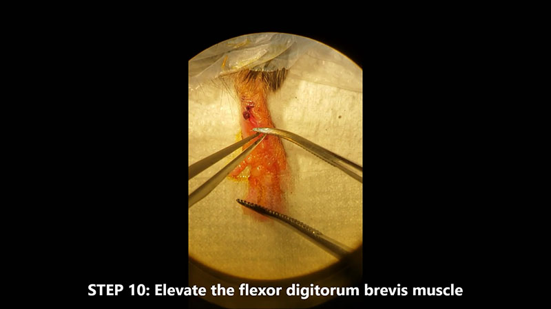 Plantar incision surgery.