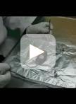 Experimental Liver Fibrosis and Intrasplenic Transplantation of CD45+ Bone Marrow Cells