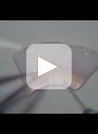 Implantation of Human Peripheral Corneal Spheres into Cadaveric Human Corneal Tissue