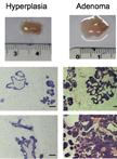 Isolation and Immortalization of  Fibroblasts from Different Tumoral Stages