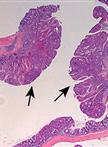 Induction of Colitis and Colitis-associated Colorectal Cancer (CAC)
