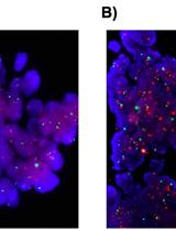 DNA <EM>in situ</EM> Hybridizations for VEGFA Gene Locus (6p12) in Human Tumor Tissue