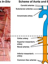 Aorta Atherosclerosis Lesion Analysis in Hyperlipidemic Mice