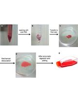Preparation of Primary Astrocyte Culture Derived from Human Glioblastoma Multiforme Specimen