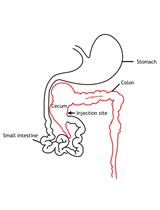 Intracaecal Orthotopic Colorectal Cancer Xenograft Mouse Model
