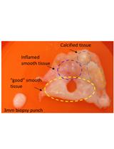 Ex vivo Model of Human Aortic Valve Bacterial Colonization