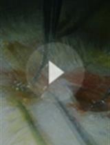 Common Carotid Arteries Occlusion Surgery in Adult Rats as a Model of Chronic Cerebral Hypoperfusion