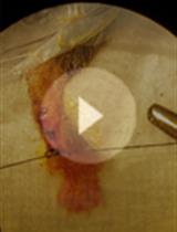 A Mouse Model of Postoperative Pain