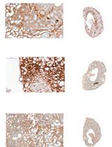 Immunohistochemistry of Kidney a-SMA, Collagen 1, and Collagen 3, in A Novel Mouse Model of Reno-cardiac Syndrome