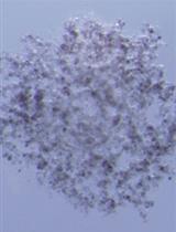 A 3D Skin Melanoma Spheroid-Based Model to Assess Tumor-Immune Cell Interactions