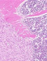 Measurement of Bone Metastatic Tumor Growth by a Tibial Tumorigenesis Assay