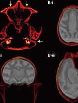 Targeted Delivery of Chemogenetic Adeno-Associated Viral Vectors to Cortical Sulcus Regions in Macaque Monkeys by Handheld Injections