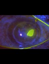 In vitro Assay to Examine the Function of Tears on Corneal Epithelial Cells
