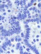 基于NanoPDLIM2的小鼠肺癌前临床联合治疗研究