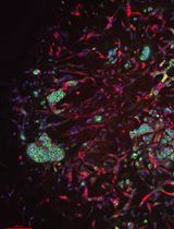 Disease Modeling in iPSC-Derived Human Bone Marrow Organoids